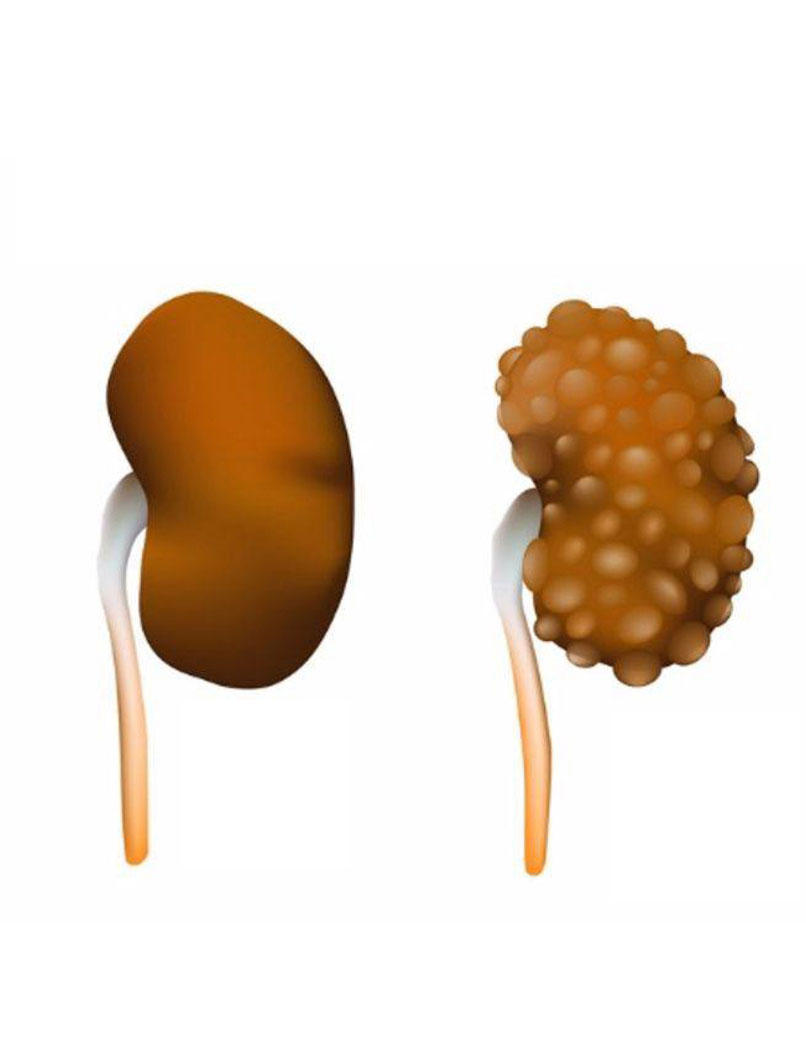 Polycystic Kidney Disease (PKD) - Mutian