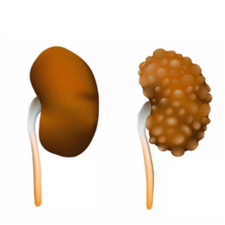 Polycystic Kidney Disease (PKD)